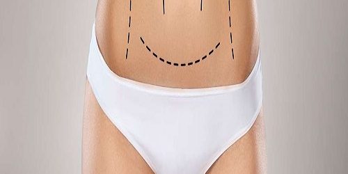 Vaser Liposuction Vaser Liposuction