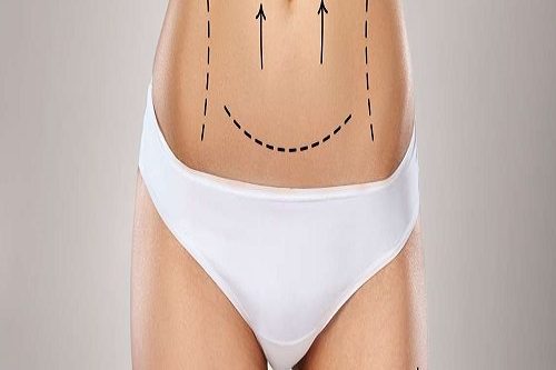Vaser Liposuction