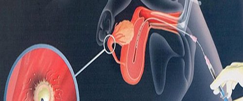 Yapay İnseminasyon Aşılama