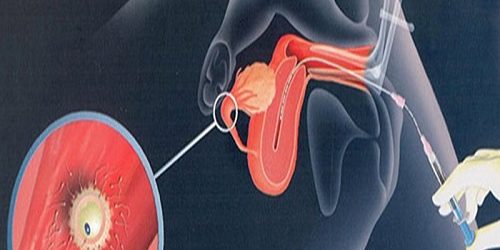 Yapay İnseminasyon Aşılama