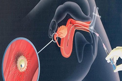 Yapay İnseminasyon Aşılama